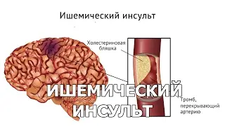 Ишемический инсульт