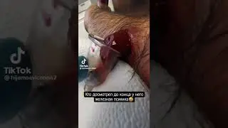 Хиджама на ноги🩸😍 Ваши ноги скажут вам спасибо 🤲🏻 89778651993