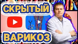 Варикоз на ногах: скрытые симптомы и советы хирурга-флеболога