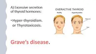 Control Of Thyroid Hormones Secretion And Hyperthyroidism & Features Of Thyrotoxicosis Grave’S Disea