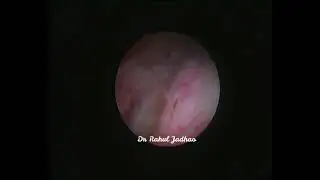 Ureteric jet with dextrose 25% at cystoscopy
