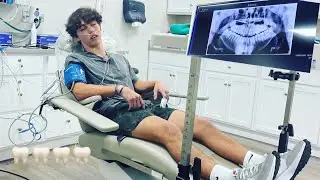 I got my wisdom teeth removed 😦🫣 #trending #instagram #tiktok #funny #trendingvideo #fup #fyp