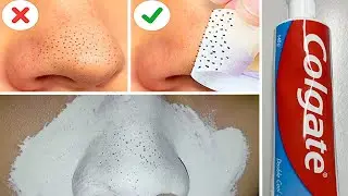 In Just 5 Mints Best Way to Remove BLACKHEADS With Toothpaste/ Toothpaste for Remove BLACKHEADS