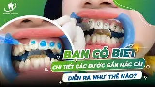 KĨ THUẬT GẮN MẮC CÀI CHO TỪNG TRƯỜNG HỢP KHI NIỀNG RĂNG