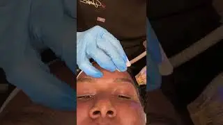 I got radio frequency microneedling for my dark spots!? #omg #microneedling #darkspotsolution