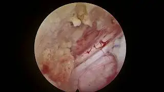 LUMBAR CANAL STENOSIS - FULL ENDOSCOPIC LUMBAR DECOMPRESSION