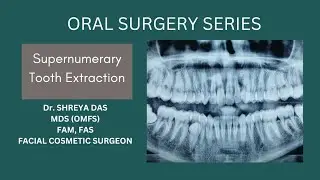 Supernumerary Tooth / Extra Tooth Surgical Extraction