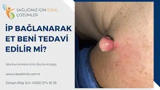 İP BAĞLANARAK ET BENİ TEDAVİ EDİLİR Mİ? -IDEA Klinik