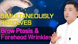 Simultaneously Resolves Brow Ptosis and Forehead Wrinkles! Summary of the Pros and Cons of Endotine