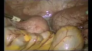 рудиментарный рог с беременностью