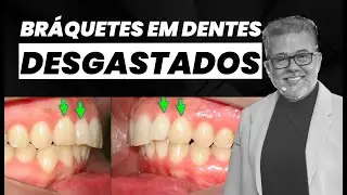 Dentes Fraturados ou Desgastados? Aprenda a Colar Bráquetes Corretamente.