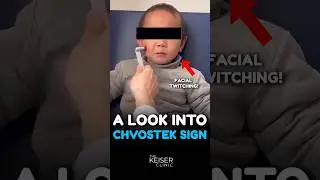 What is Chvostek Sign? 