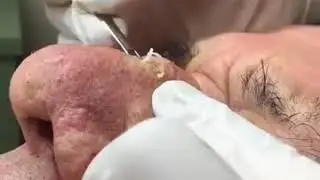 Выдавливание черной точки на носу
