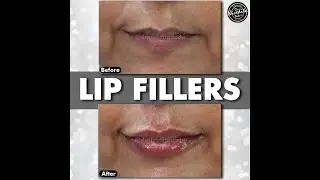 Lip Fillers | Before After | Dr. Nivedita Dadu's Dermatology Clinic