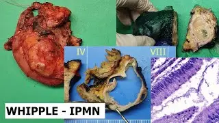 Whipple's procedure - IPMN (#1)
