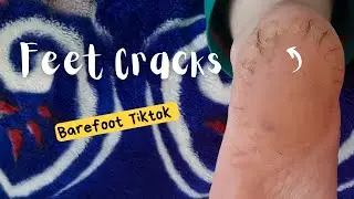 Why do we get cracks in our feet | How can we treat our cracks | Barefoot tiktok