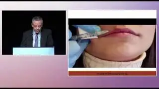 Safe Lip filler IMCAS 2019 (Summary)