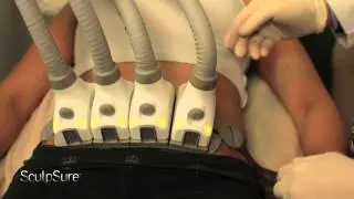 The Future of Fat Loss: Non-Surgical Laser called SculpSure