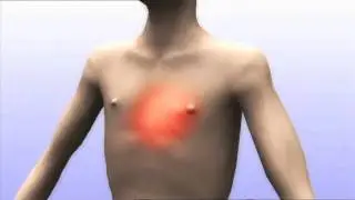 Wat is angina pectoris?
