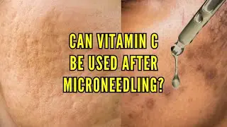 DOES MICRONEEDLING WITH VITAMIN C CAUSE GRANULOMAS?