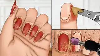 ASMR Treatment chemical nail fungus and skin abrasions | Nail care animation