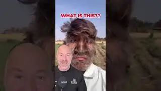 Rare Werewolf Syndrome Disease 🐺 