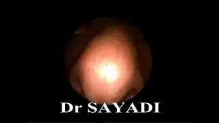 tumeur du cavum Carcinome de type nasopharyngé