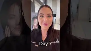 Watch my Jeuveau kick in! See results about 2 weeks after your appointment