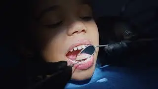 The traditional method of scaling teeth