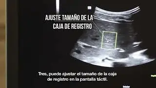 Elastografía Cuantitativa Sound Touch Cuantification STQ