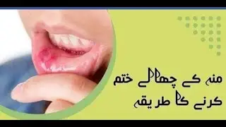 Moo ky chaly khtm krny ka ilaj