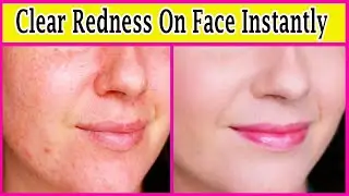 Best DIY Face Mask That Reduce Redness On Your Face | Clear Redness Red Spots Instantly