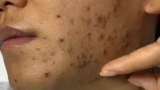 [ASMR] Blackhead Removal & Acne Treatment Facial Cleansing Routine