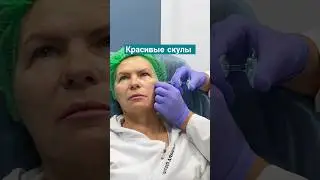 Красивые скулы филлерами.