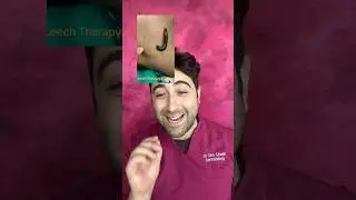 Using a LEECH to treat ACNE ?
