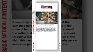 Diskectomy 