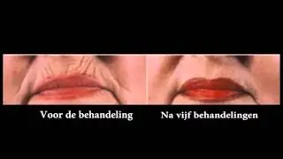 RIMPELBEHANDELING, DIEPE RIMPELS BEHANDELD MET DE BIO MELT METHODE