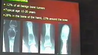 Bone tumers 1