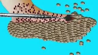 ASMR Treatment 2D Animation | Maggot Infected Dirty Foot | @HealAsmr914K