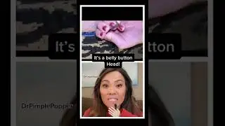 Dr Pimple Popper POPS Belly Button Comedone!