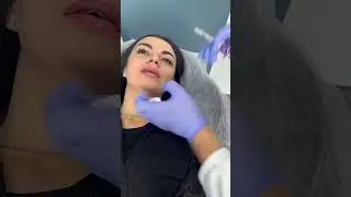 Увеличение губ филлерами. 
