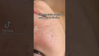 a Disgustingly Satisfying Pimple-Popping, Zit-Exploding Tiktok Video Compilation for Popaholics.