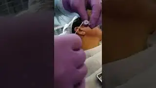 НИТЕВОЙ ЛИФТИНГ субментальной зоны нитями DUAL 19C *550 мм. ⬆️⬆️⬆️