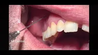 Complicated Tooth Extraction  !!!!!!