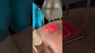 Co2 Laser Resurfacing up close 👀helps pigmentation + sunspots + fine lines and wrinkles! #trending
