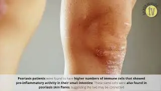 Inflammation may be linked to stomach problems in psoriasis patients
