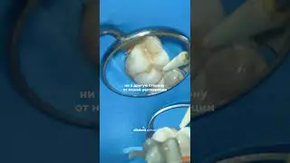 Все что нужно знать о полировке зубов!