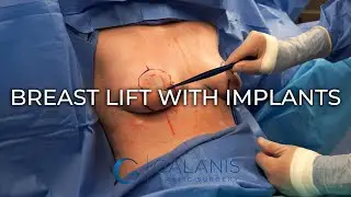 Breast Lift with Implants | Galanis Plastic Surgery | Surgery