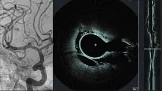 Volumetric microscopy of cerebral arteries with a miniaturized imaging probe