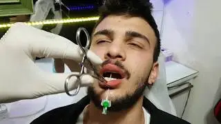 Erkek Dudak | Labret | Lip Piercing Delim Sonrası İlk Değişim ??